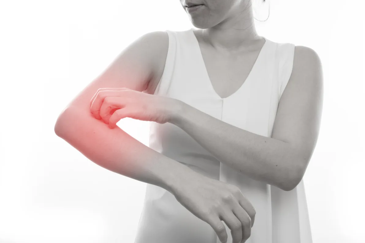 jeuk en bultjes door stress